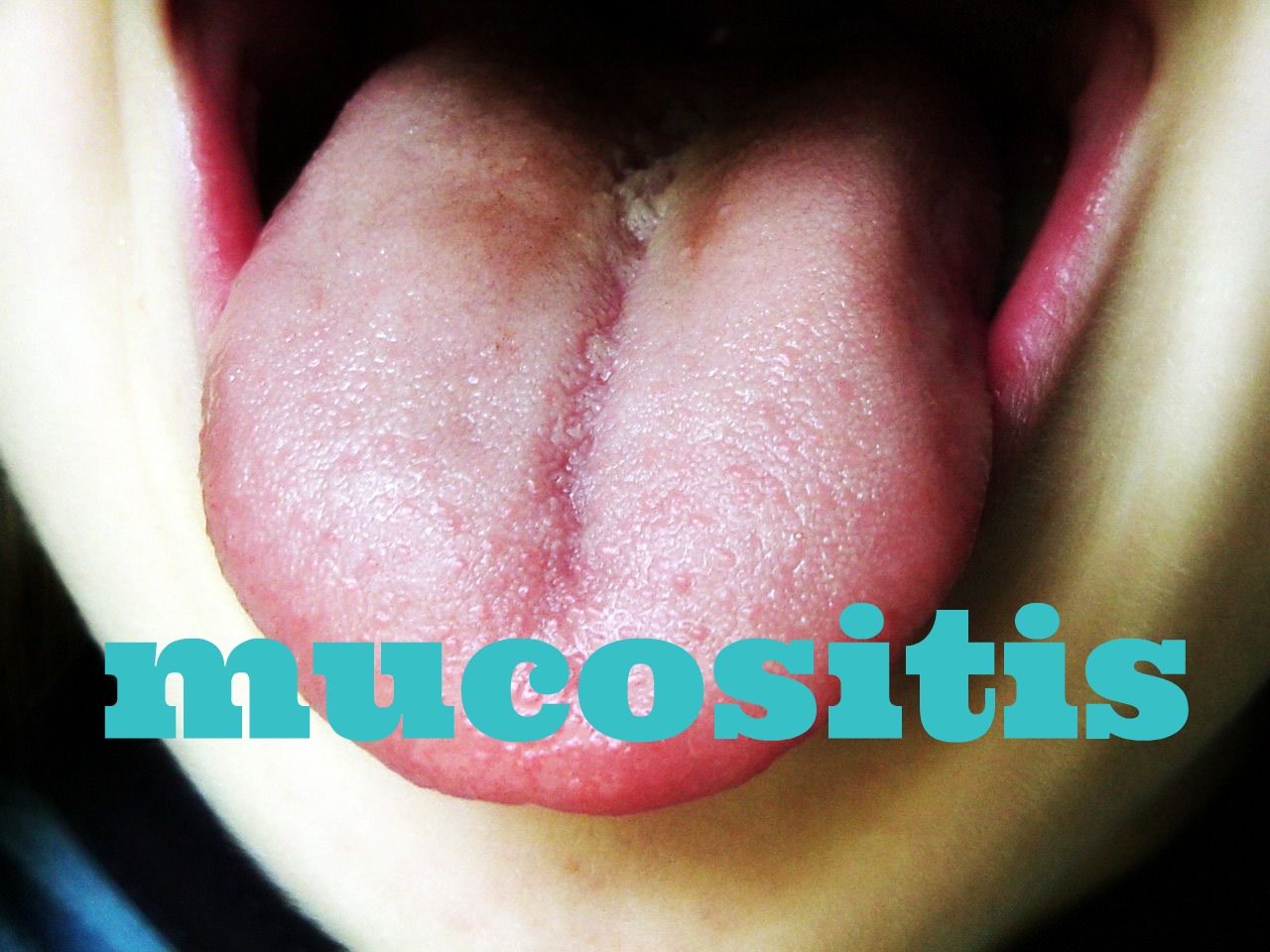 Managing Mucositis